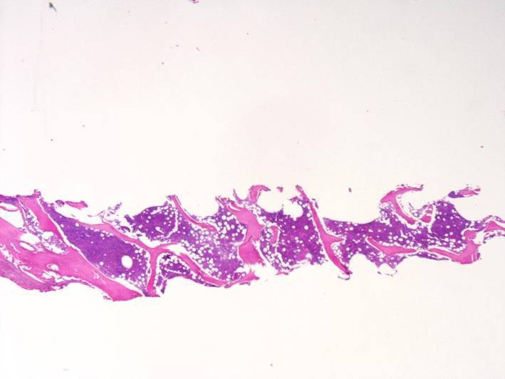 second bone marrow